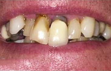 Severely damaged and decayed top teeth