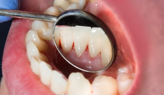 Dentist examining patient's smile with gum disease symptoms present