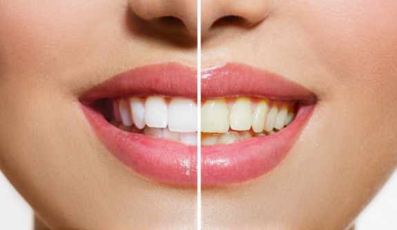 Smile before and after teeth whitening