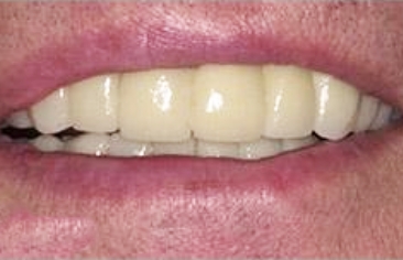 Healthy beautiful smile after dental treatment