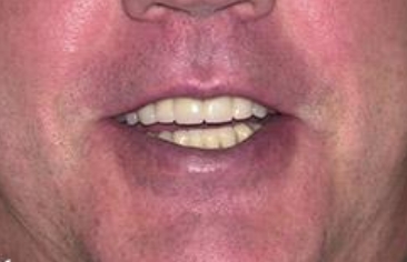 Flawless smile after dental treatment