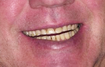 Worn teeth before dental treatment