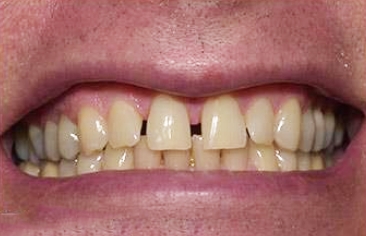 Smile with gaps between teeth