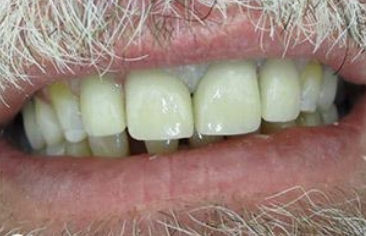 Gap between front teeth closed