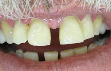 Smile with large gap between front teeth