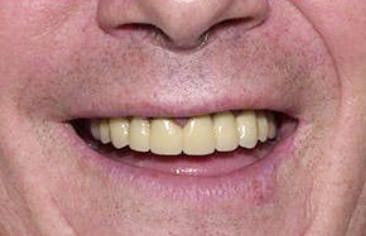 Flawless new dental restoration
