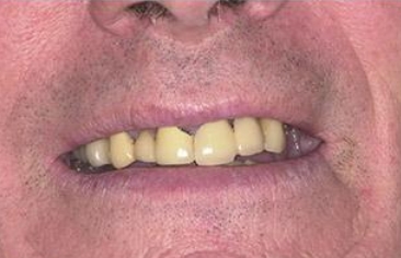 Darkly colored old dental restoration with dark coloring at the gum line