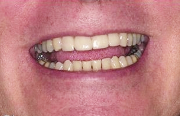 Evenly spaced teeth after treatment