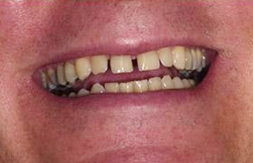 Unevenly spaced teeth