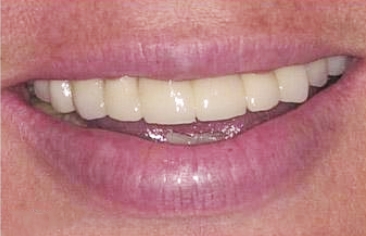 Flawless white smile after dental treatment