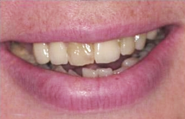 Smile with darkly colored and damaged front tooth