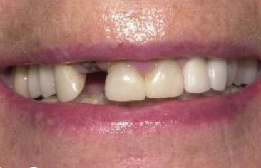 Smile with missing top tooth