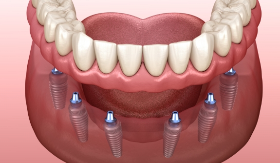 Animated smile showing full mouth reconstruction with dental implant supported dentures