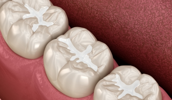 Animated smile with dental sealants