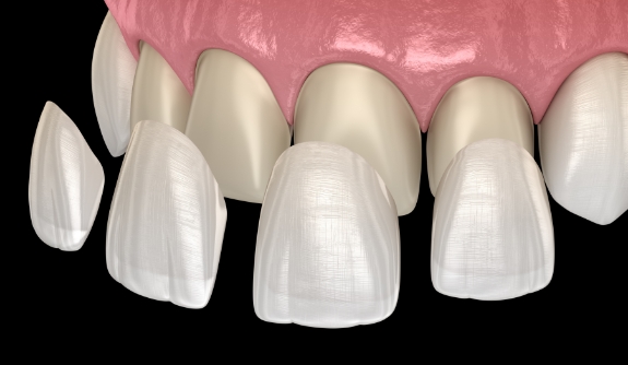 Animated smile during dental bonding treatment