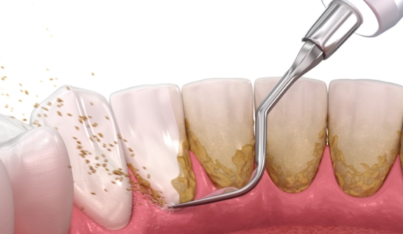 Animated smile during scaling and root planing treatment