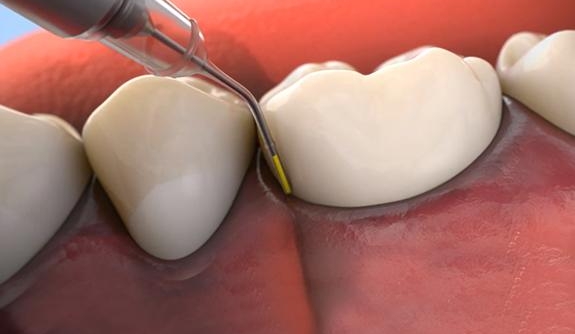 Animated smile during antibiotic therapy