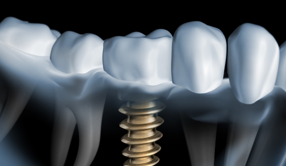 Animated smile with dental implant supported replacement tooth