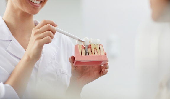 Dentist using smile model to explain the four step dental implant process