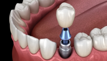 Animated smile during dental implant supported dental crown placement