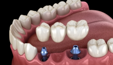 Animated smile during dental implant supported fixed bridge