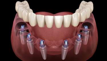 Animated smile during dental implant supported denture placement