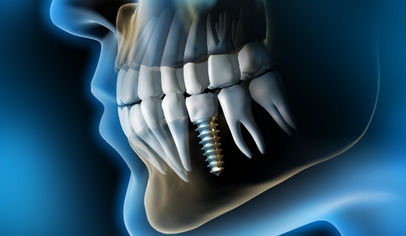 Animated smile with dental implant supported dental crown