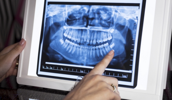 Digital dental x-rays